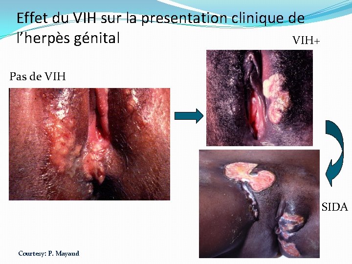 Effet du VIH sur la presentation clinique de l’herpès génital VIH+ Pas de VIH