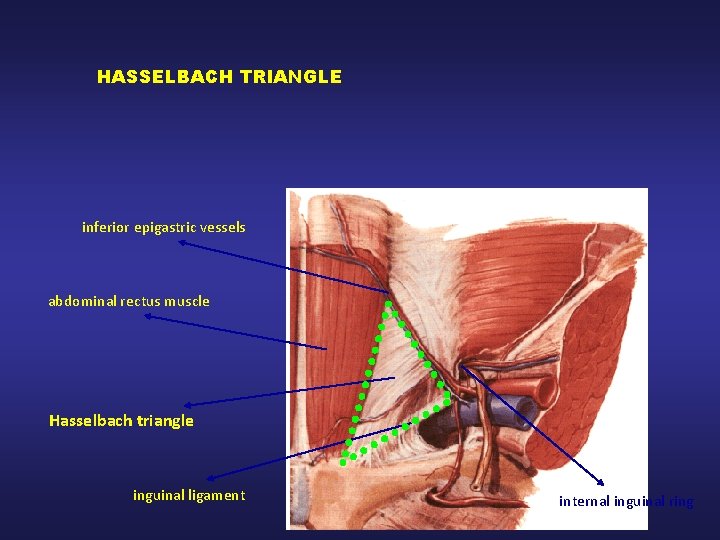 HASSELBACH TRIANGLE inferior epigastric vessels abdominal rectus muscle Hasselbach triangle inguinal ligament internal inguinal