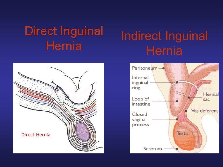 Direct Inguinal Hernia 