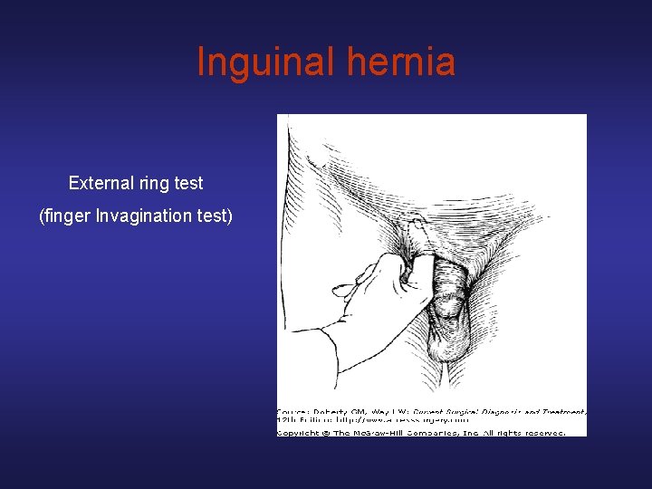 Inguinal hernia External ring test (finger Invagination test) 