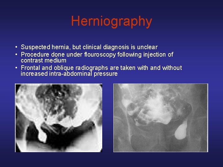 Herniography • Suspected hernia, but clinical diagnosis is unclear • Procedure done under flouroscopy