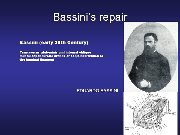 Bassini’s repair Bassini (early 20 th Century) Transversus abdominis and internal oblique musculoaponeurotic arches