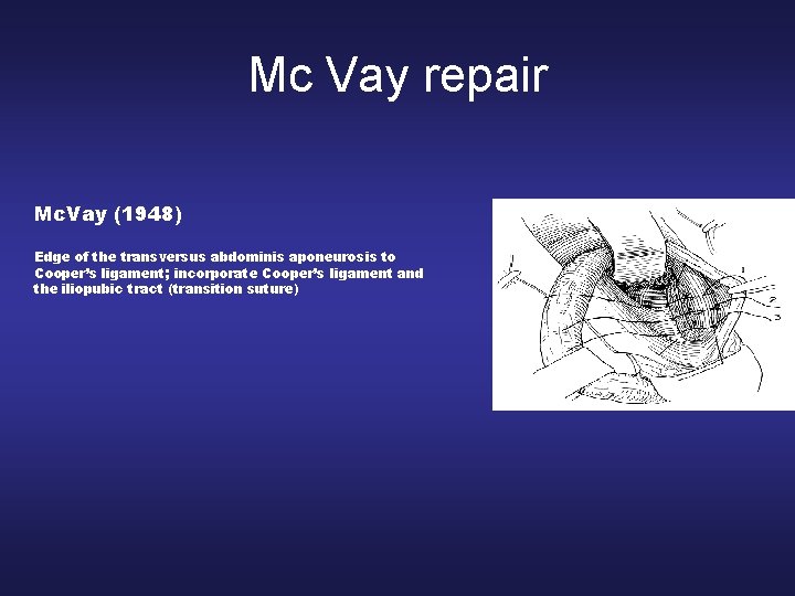 Mc Vay repair Mc. Vay (1948) Edge of the transversus abdominis aponeurosis to Cooper’s