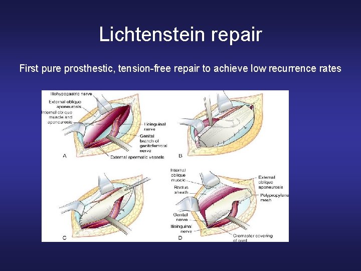 Lichtenstein repair First pure prosthestic, tension-free repair to achieve low recurrence rates 