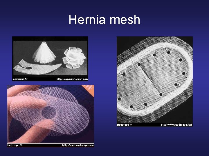 Hernia mesh 