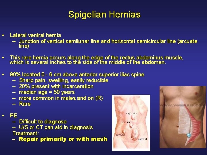 Spigelian Hernias • Lateral ventral hernia – Junction of vertical semilunar line and horizontal