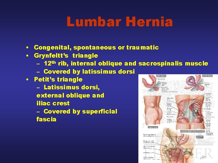Lumbar Hernia • Congenital, spontaneous or traumatic • Grynfeltt’s triangle – 12 th rib,