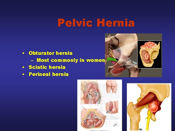 Pelvic Hernia • Obturator hernia – Most commonly in women • Sciatic hernia •