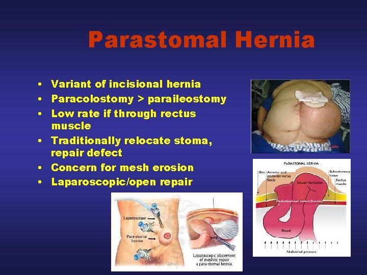 Parastomal Hernia • Variant of incisional hernia • Paracolostomy > paraileostomy • Low rate