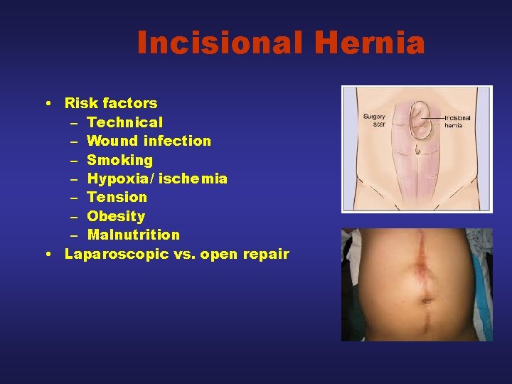 Incisional Hernia • Risk factors – Technical – Wound infection – Smoking – Hypoxia/