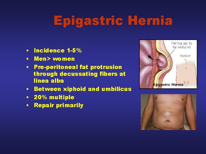 Epigastric Hernia • Incidence 1 -5% • Men> women • Pre-peritoneal fat protrusion through