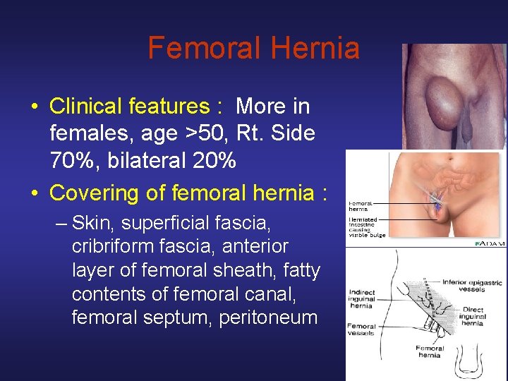 Femoral Hernia • Clinical features : More in females, age >50, Rt. Side 70%,