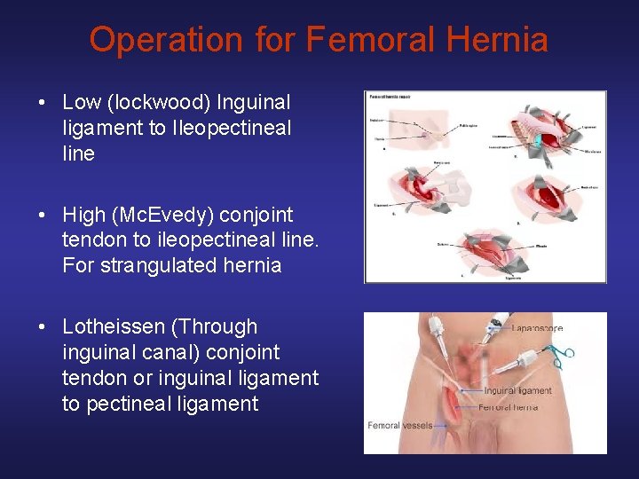 Operation for Femoral Hernia • Low (lockwood) Inguinal ligament to Ileopectineal line • High