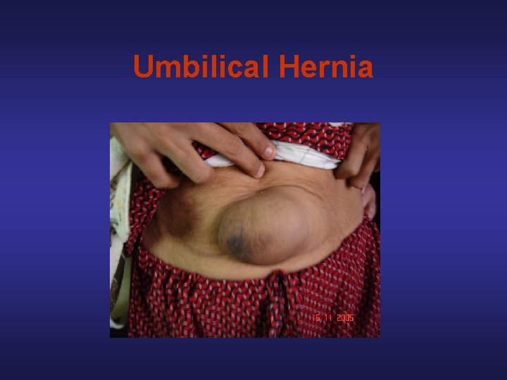 Umbilical Hernia 