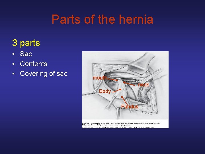 Parts of the hernia 3 parts • Sac • Contents • Covering of sac