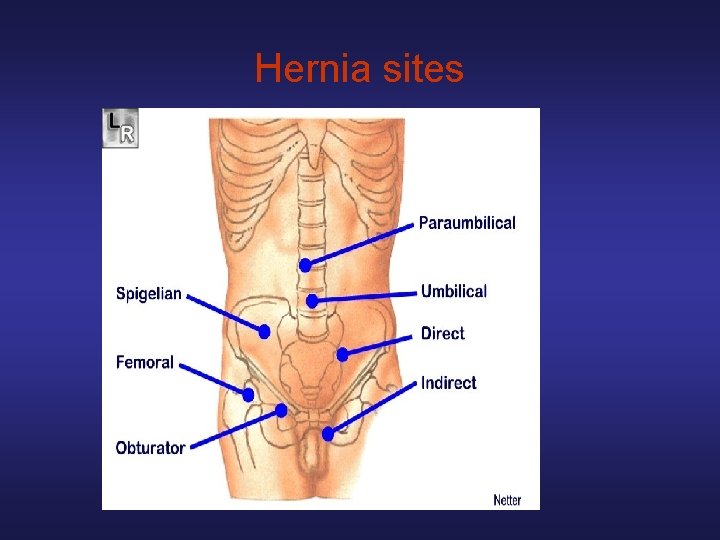 Hernia sites 