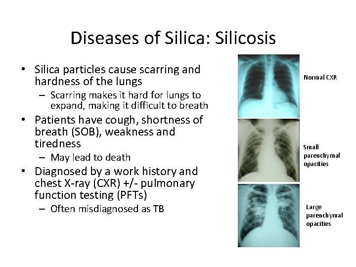 Diseases of Silica: Silicosis • Silica particles cause scarring and hardness of the lungs Diseases of Silica: Silicosis • Silica particles cause scarring and hardness of the lungs