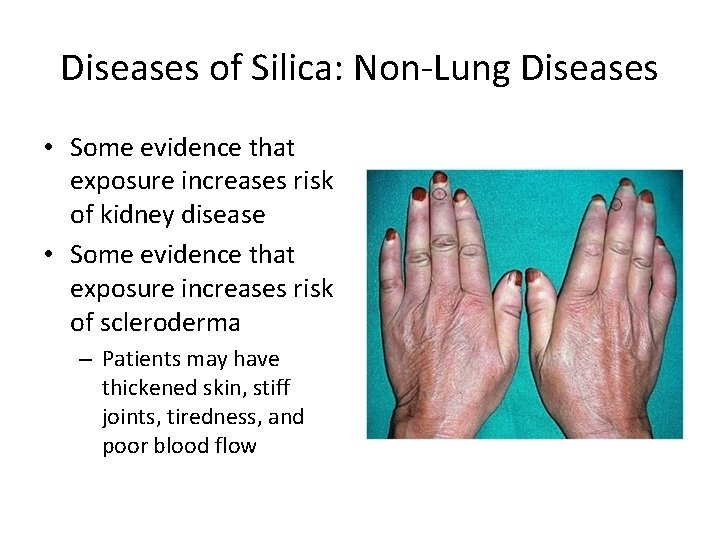 Diseases of Silica: Non-Lung Diseases • Some evidence that exposure increases risk of kidney Diseases of Silica: Non-Lung Diseases • Some evidence that exposure increases risk of kidney