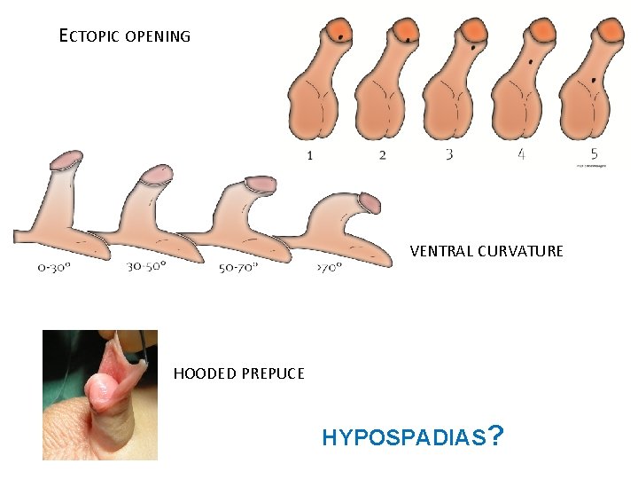 ECTOPIC OPENING VENTRAL CURVATURE HOODED PREPUCE HYPOSPADIAS? 