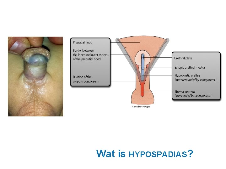 Wat is HYPOSPADIAS? 