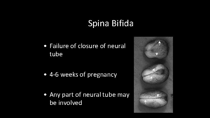 Spina Bifida • Failure of closure of neural tube • 4 -6 weeks of