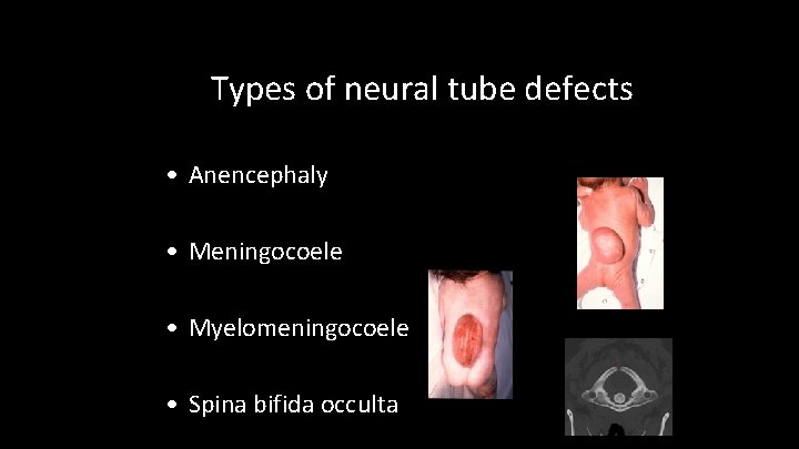 Types of neural tube defects • Anencephaly • Meningocoele • Myelomeningocoele • Spina bifida