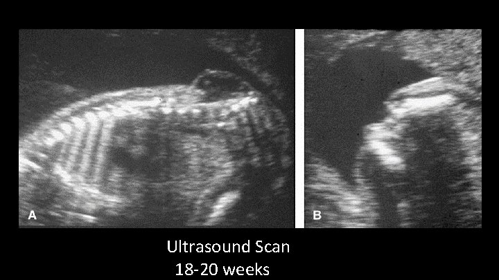 Ultrasound Scan 18 -20 weeks 
