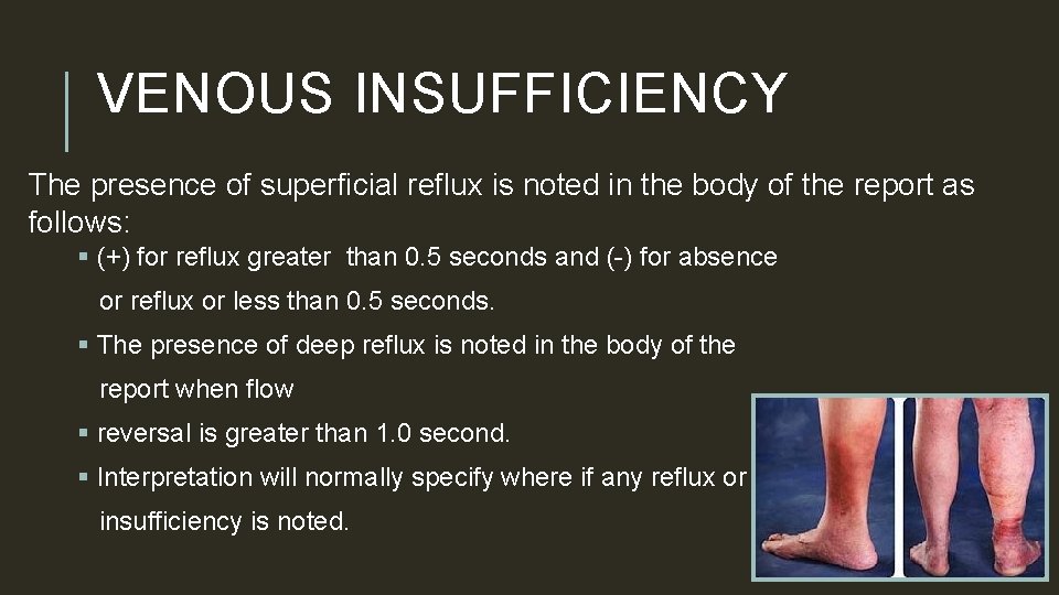 VENOUS INSUFFICIENCY The presence of superficial reflux is noted in the body of the