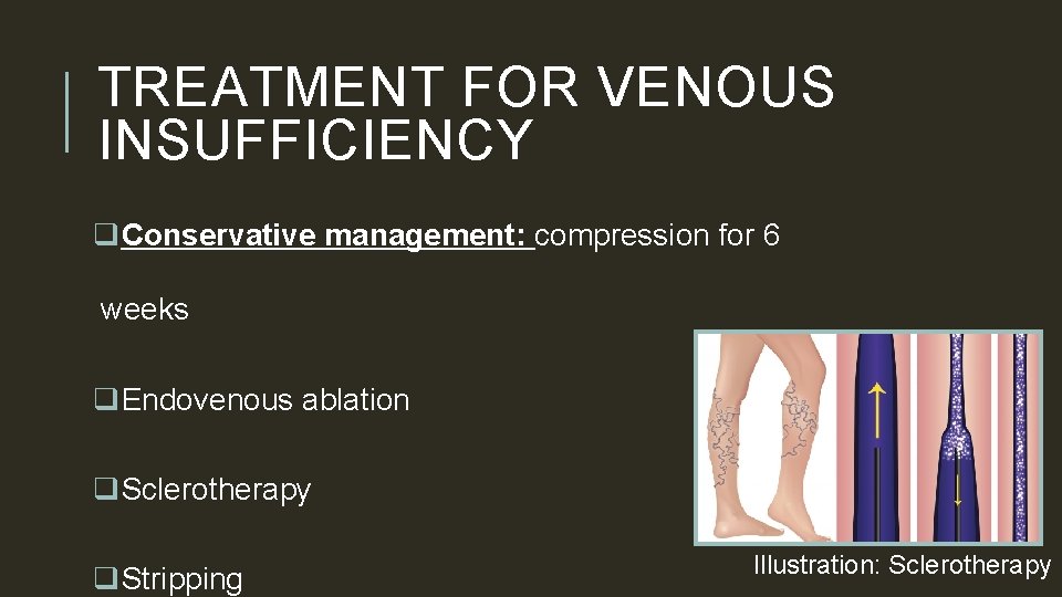 TREATMENT FOR VENOUS INSUFFICIENCY q. Conservative management: compression for 6 weeks q. Endovenous ablation