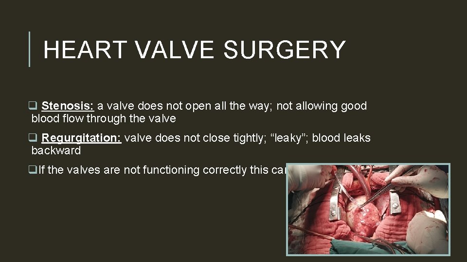 HEART VALVE SURGERY q Stenosis: a valve does not open all the way; not