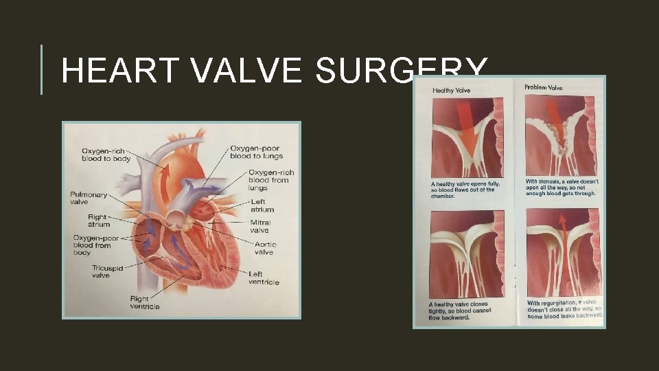 HEART VALVE SURGERY 