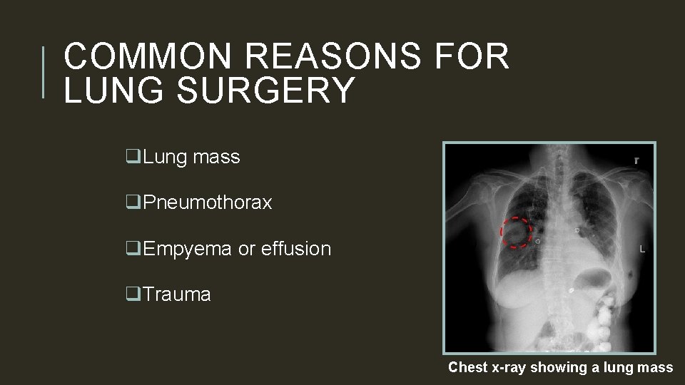 COMMON REASONS FOR LUNG SURGERY q. Lung mass q. Pneumothorax q. Empyema or effusion