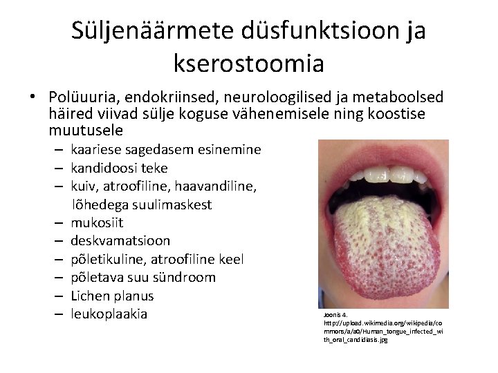 Süljenäärmete düsfunktsioon ja kserostoomia • Polüuuria, endokriinsed, neuroloogilised ja metaboolsed häired viivad sülje koguse