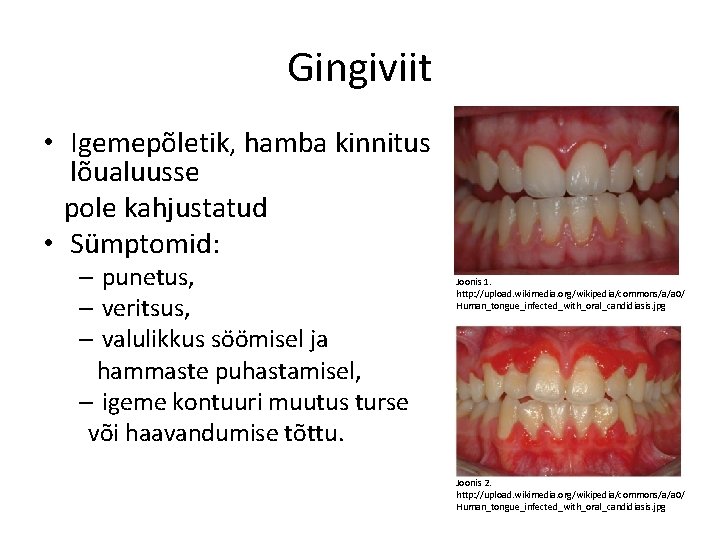 Gingiviit • Igemepõletik, hamba kinnitus lõualuusse pole kahjustatud • Sümptomid: – punetus, – veritsus,