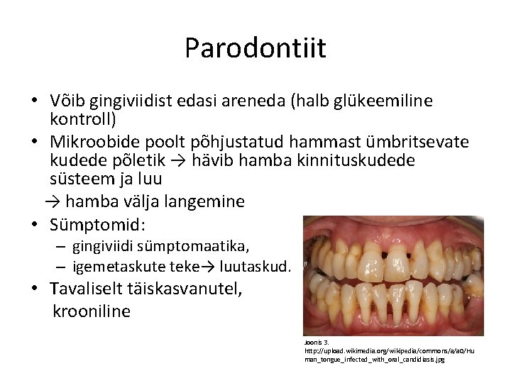 Parodontiit • Võib gingiviidist edasi areneda (halb glükeemiline kontroll) • Mikroobide poolt põhjustatud hammast