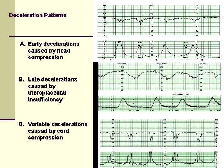 Deceleration Patterns A. Early decelerations caused by head compression B. Late decelerations caused by