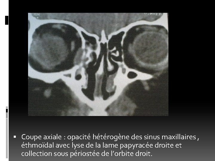  Coupe axiale : opacité hétérogène des sinus maxillaires , éthmoïdal avec lyse de