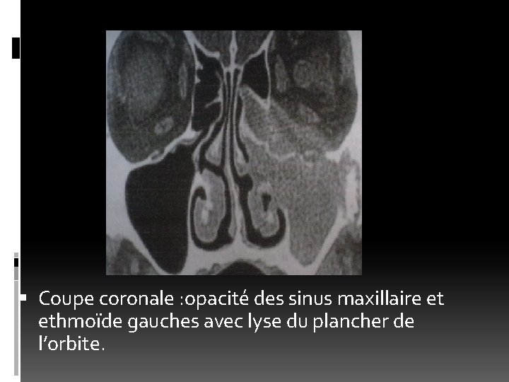  Coupe coronale : opacité des sinus maxillaire et ethmoïde gauches avec lyse du