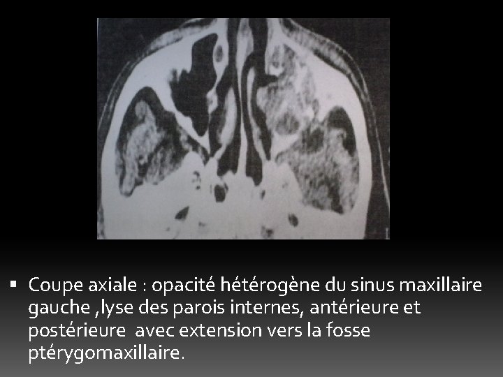  Coupe axiale : opacité hétérogène du sinus maxillaire gauche , lyse des parois