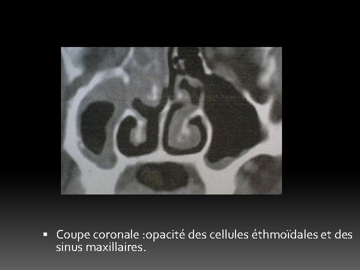  Coupe coronale : opacité des cellules éthmoïdales et des sinus maxillaires. 