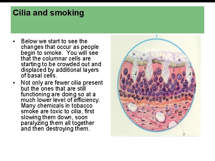 Cilia and smoking • Below we start to see the changes that occur as
