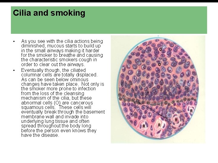 Cilia and smoking • • As you see with the cilia actions being diminished,