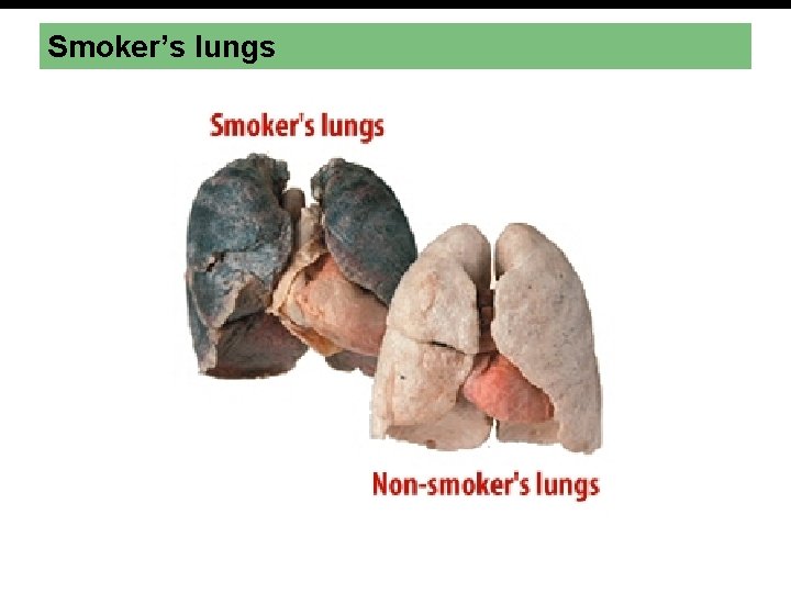 Smoker’s lungs 