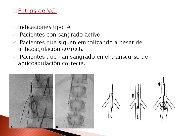 � Filtros ü ü ü de VCI Indicaciones tipo IA: Pacientes con sangrado activo