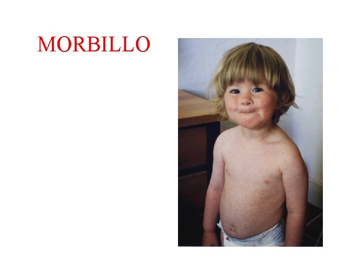 MORBILLO 