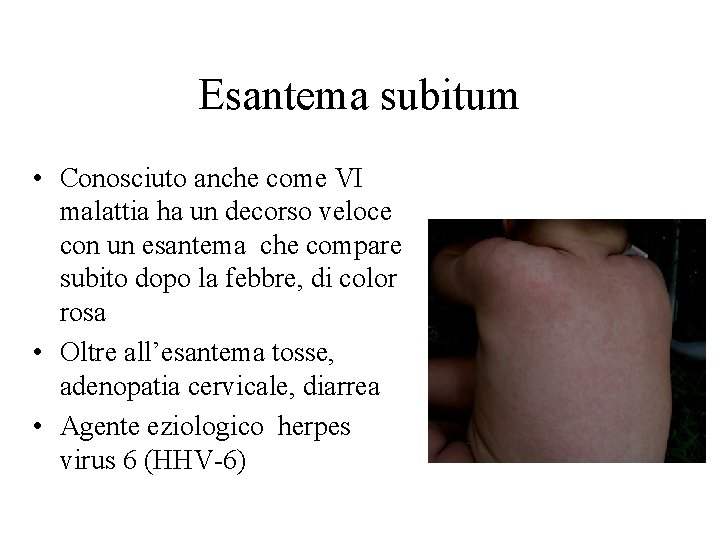 Esantema subitum • Conosciuto anche come VI malattia ha un decorso veloce con un
