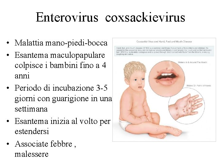 Enterovirus coxsackievirus • Malattia mano-piedi-bocca • Esantema maculopapulare colpisce i bambini fino a 4