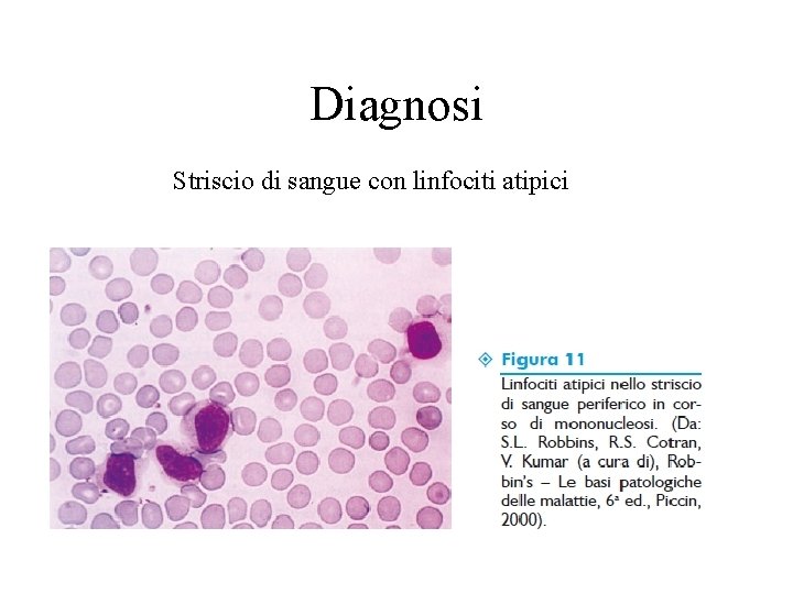 Diagnosi Striscio di sangue con linfociti atipici 