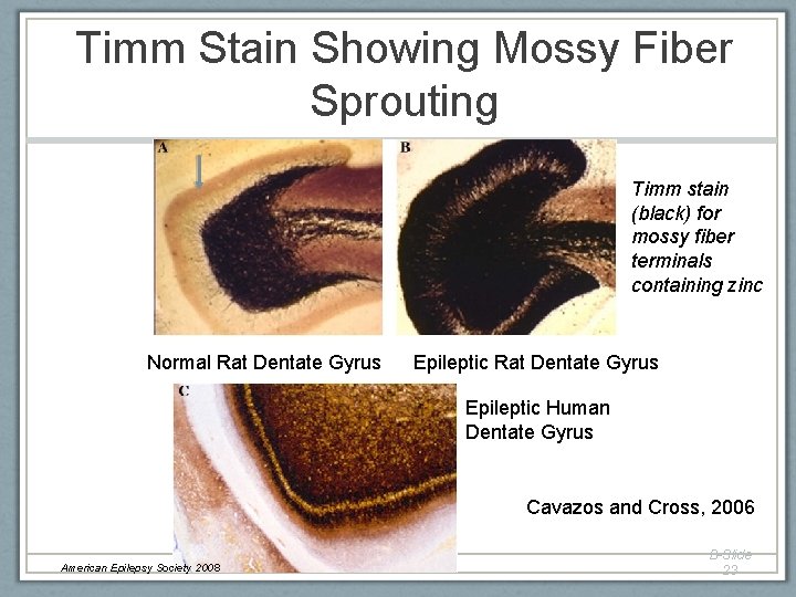 Timm Stain Showing Mossy Fiber Sprouting Timm stain (black) for mossy fiber terminals containing