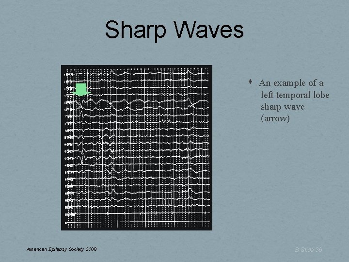 Sharp Waves An example of a left temporal lobe sharp wave (arrow) American Epilepsy Sharp Waves An example of a left temporal lobe sharp wave (arrow) American Epilepsy